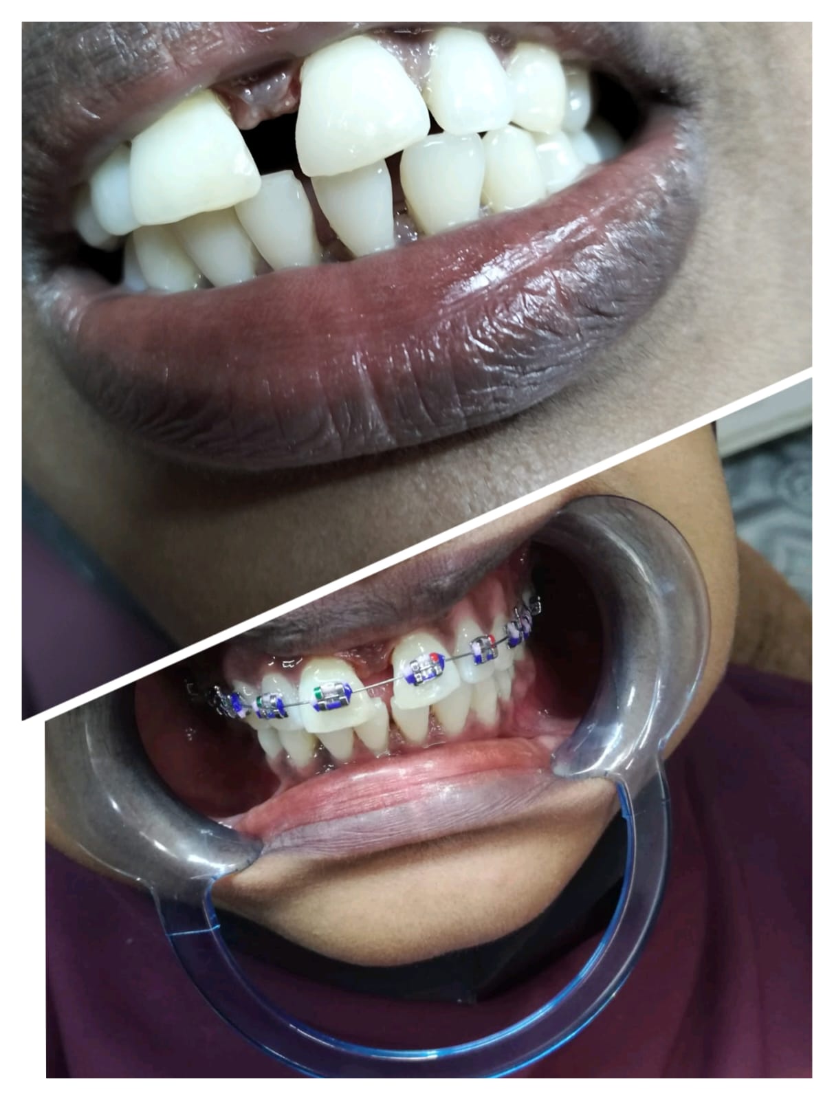রুট ক্যানাল চিকিৎসা